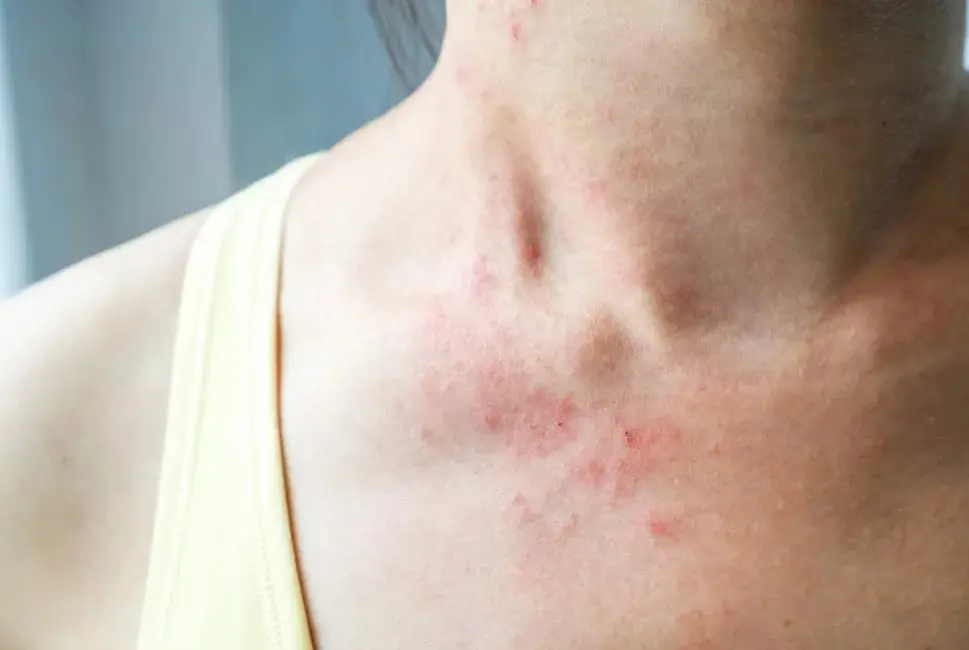 Sindrome Di Stevens-Johnson: immagine introduttiva