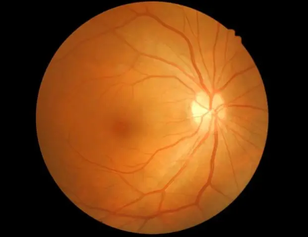 Fluorangiografia Retinica: immagine introduttiva